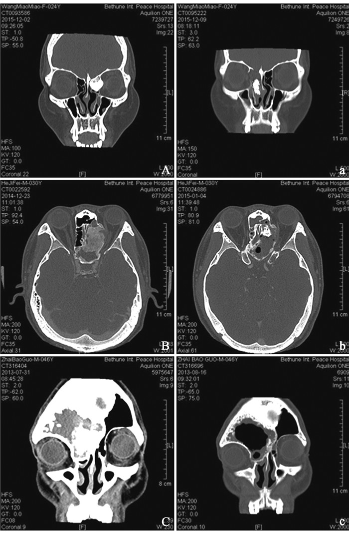 累及鼻颅底区域鼻腔鼻窦骨源性良性肿瘤的鼻内镜手术